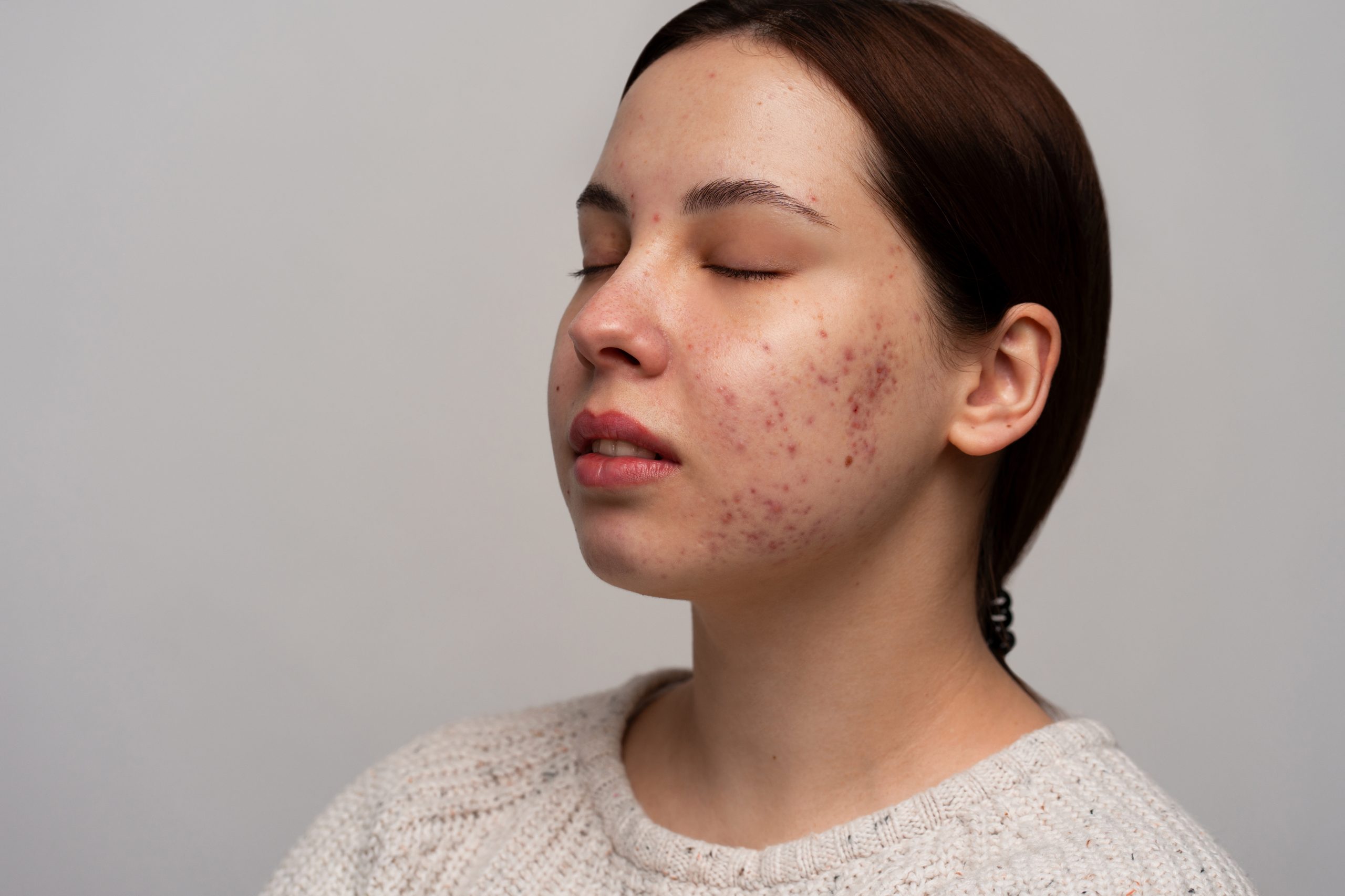 Best Acne Scars Treatment in Kolkata - Cost, Procedures & Results - La Derma