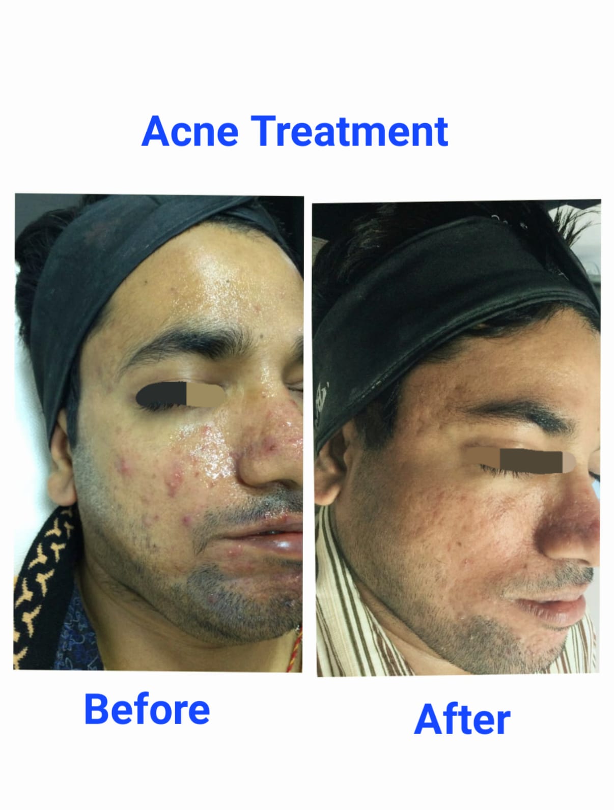 Acne Pimple Treatment