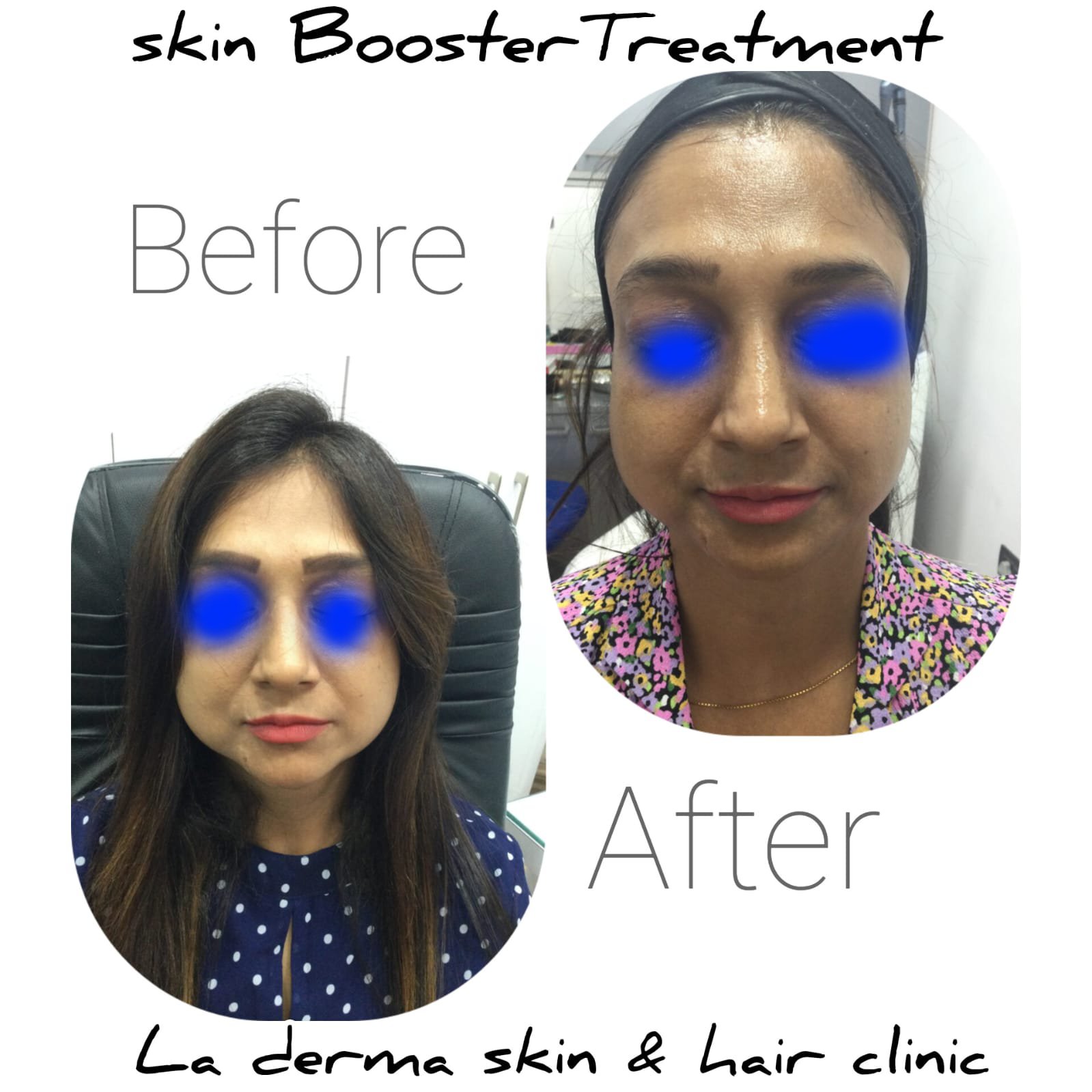 Permanent Skin Whitening Treatment in Kolkata IV Glutathione