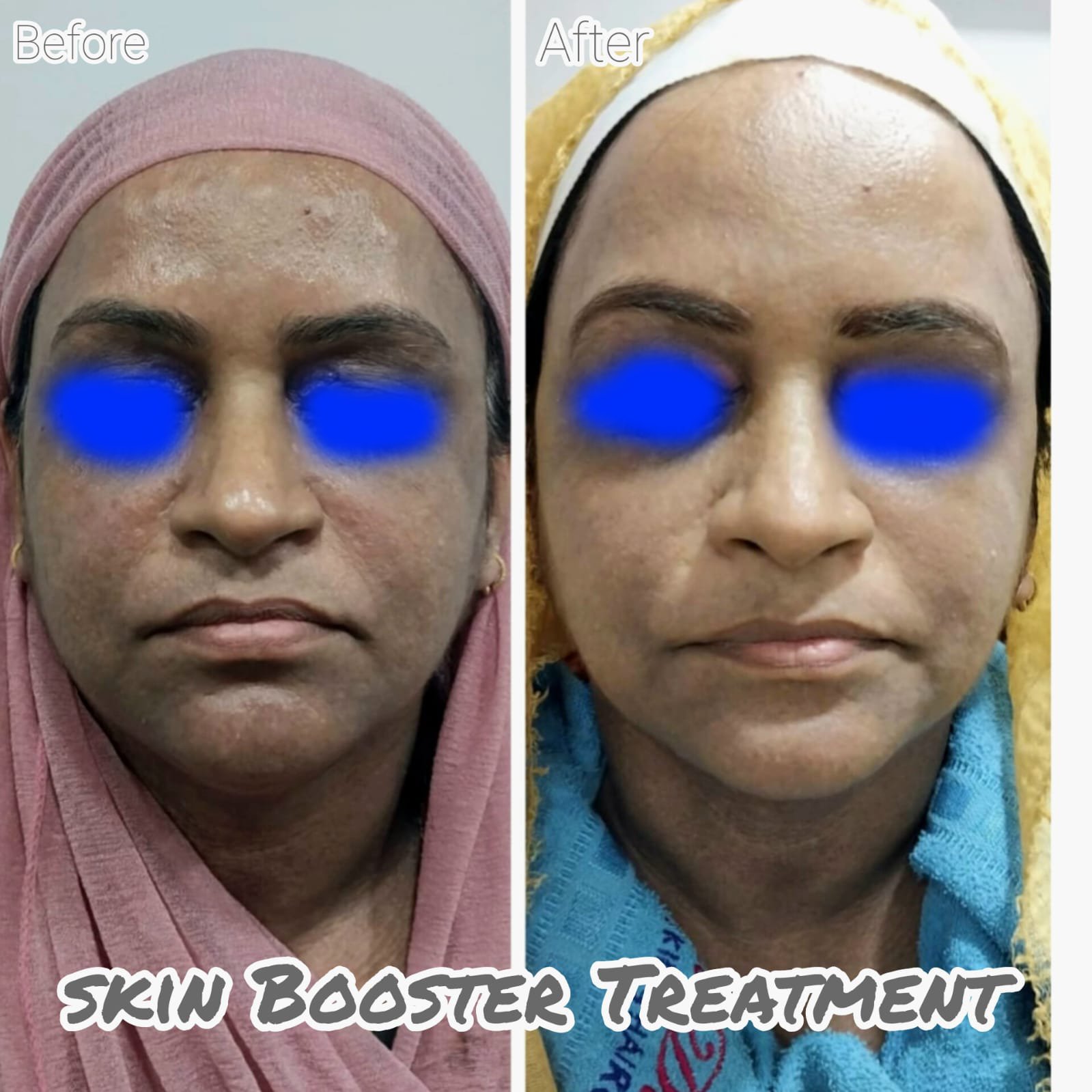 Permanent Skin Whitening Treatment in Kolkata IV Glutathione