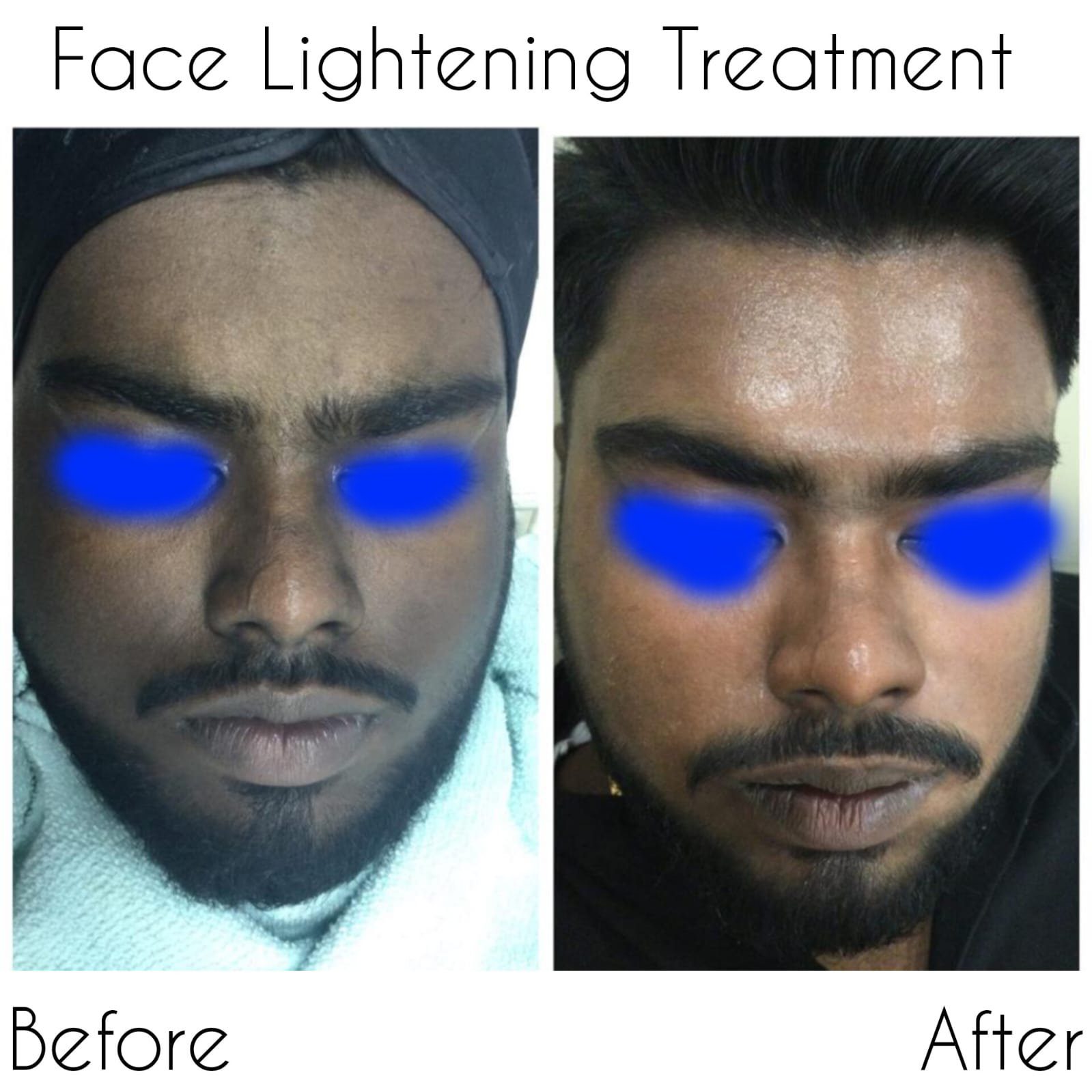 Glutathione IV Treatment