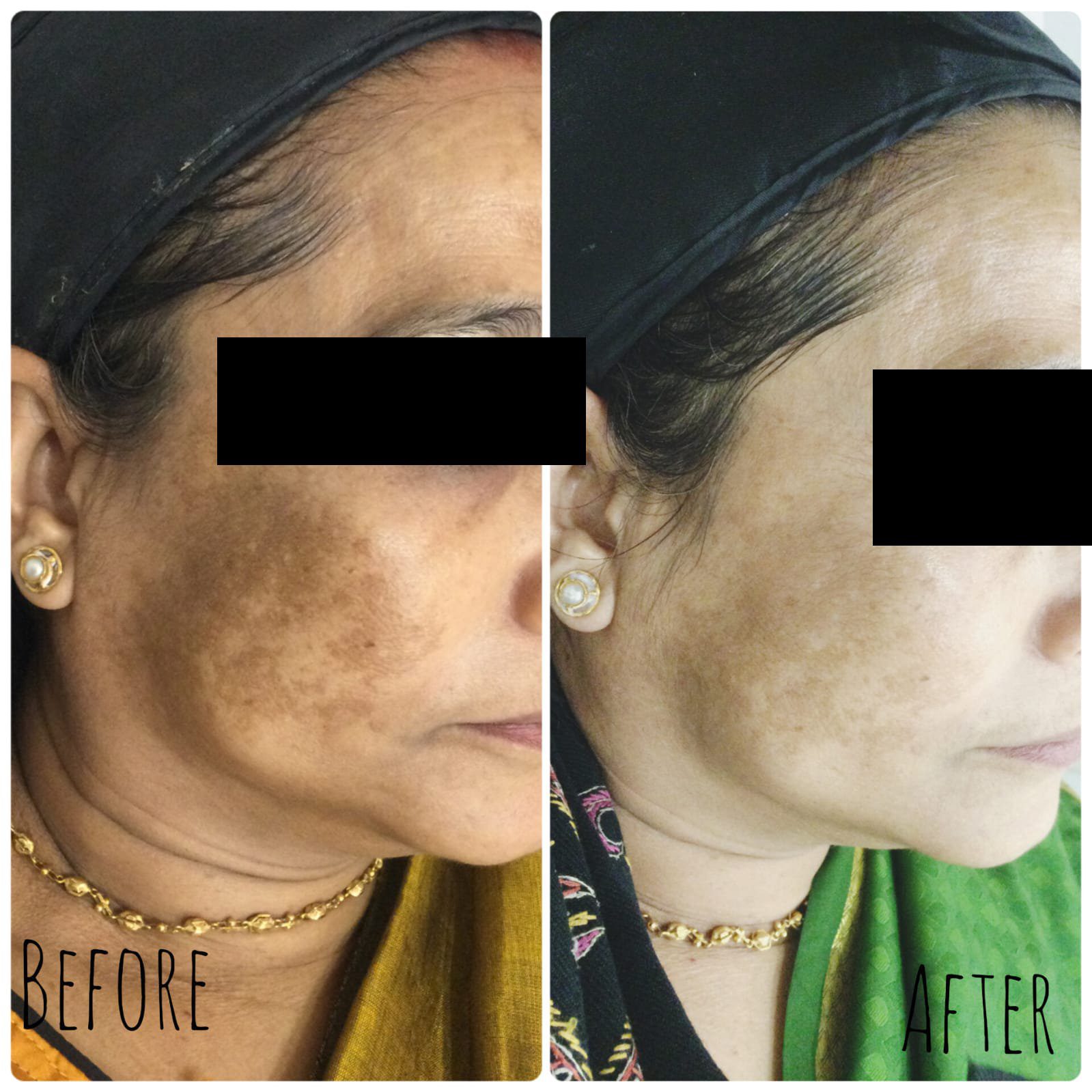 Pigmentation