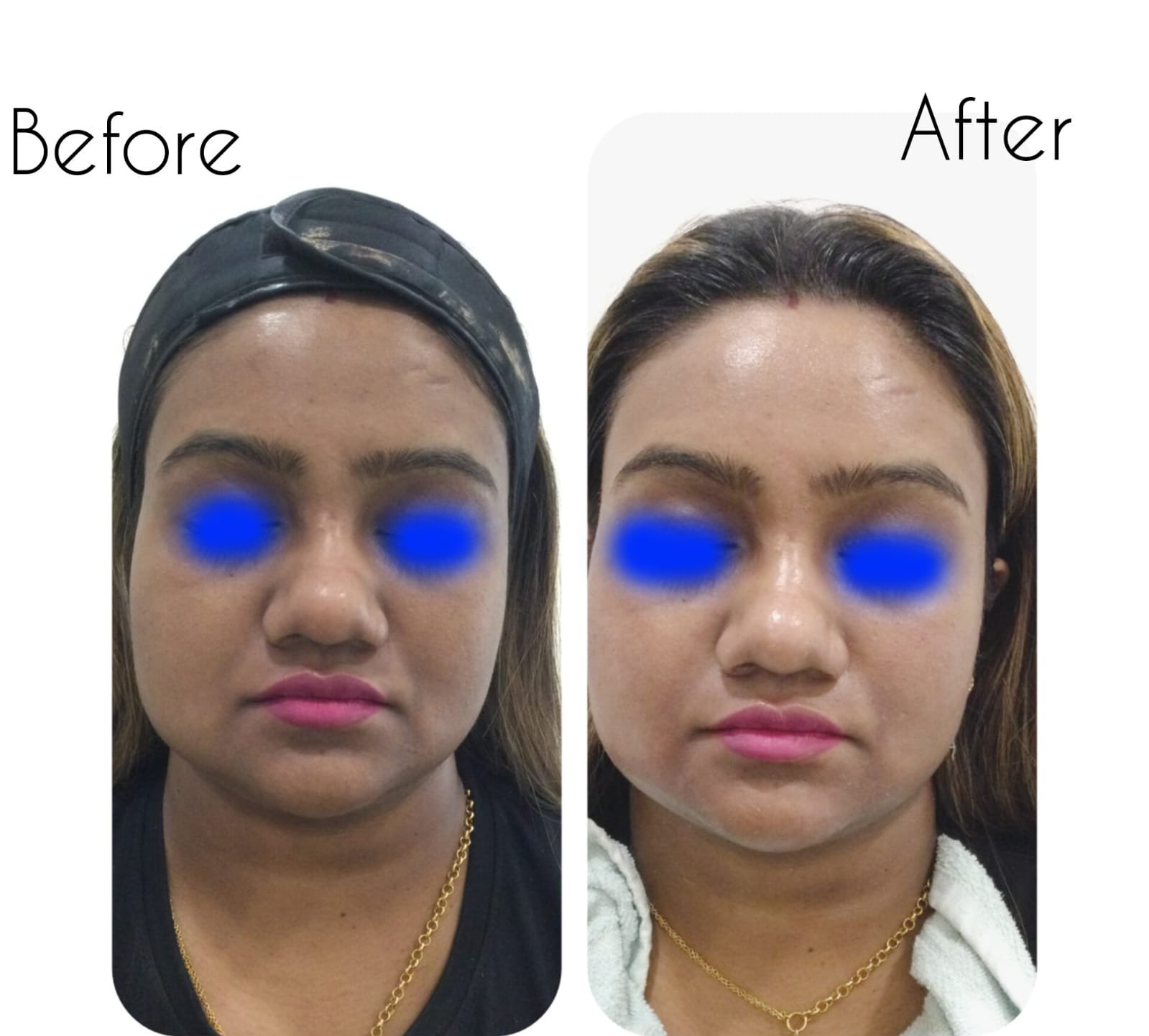 Permanent Skin Whitening Treatment in Kolkata IV Glutathione