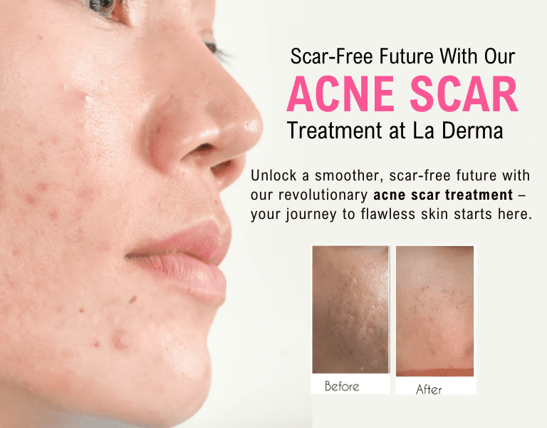 Acne Scars Treatment