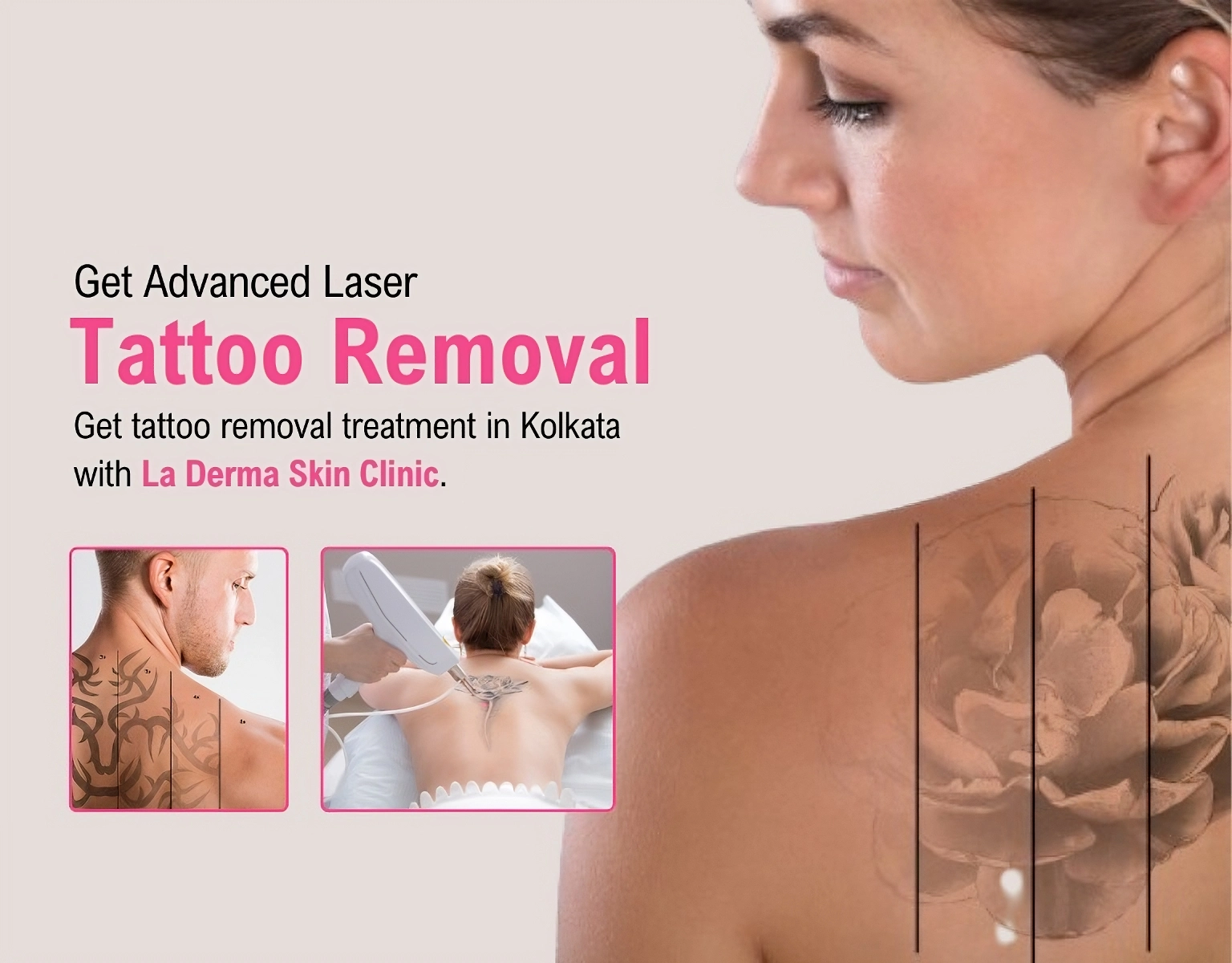 Tattoo Removal Treatment Near You in Kolkata