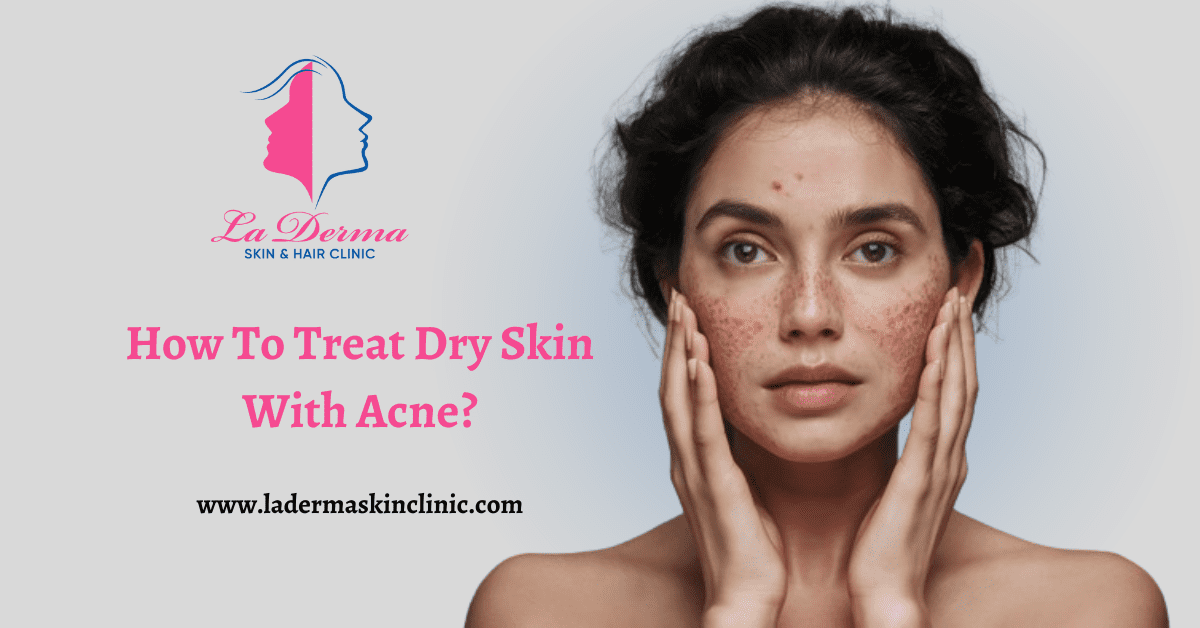 How To Treat Dry Skin With Acne La Derma Skin Clinic Kolkata