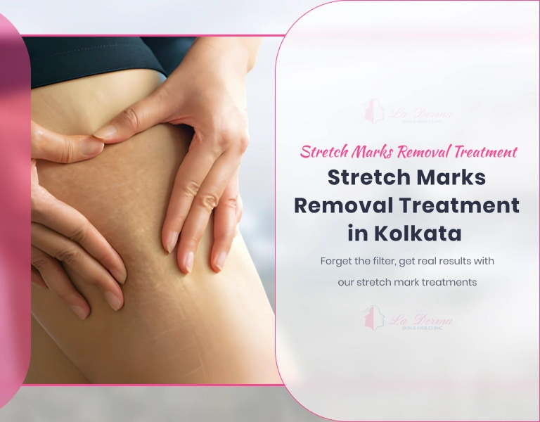 Stretch Marks Removal Treatment