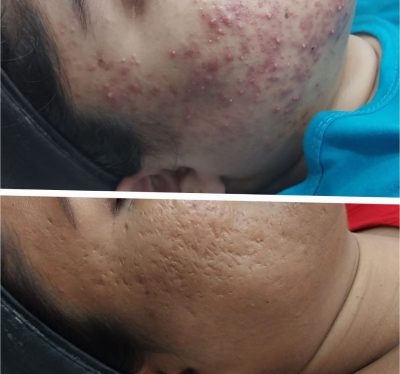 Acne Treatment