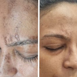 Dark Spots