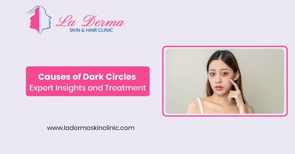 Causes of Dark Circles, Expert Insights and Treatment