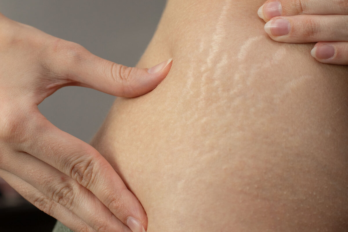https://ladermaskinclinic.com/wp-content/uploads/2025/10/Cellulite-Stretch-Mark-Toning.jpg