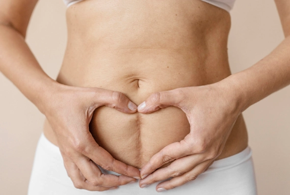 What Are Stretch Marks?