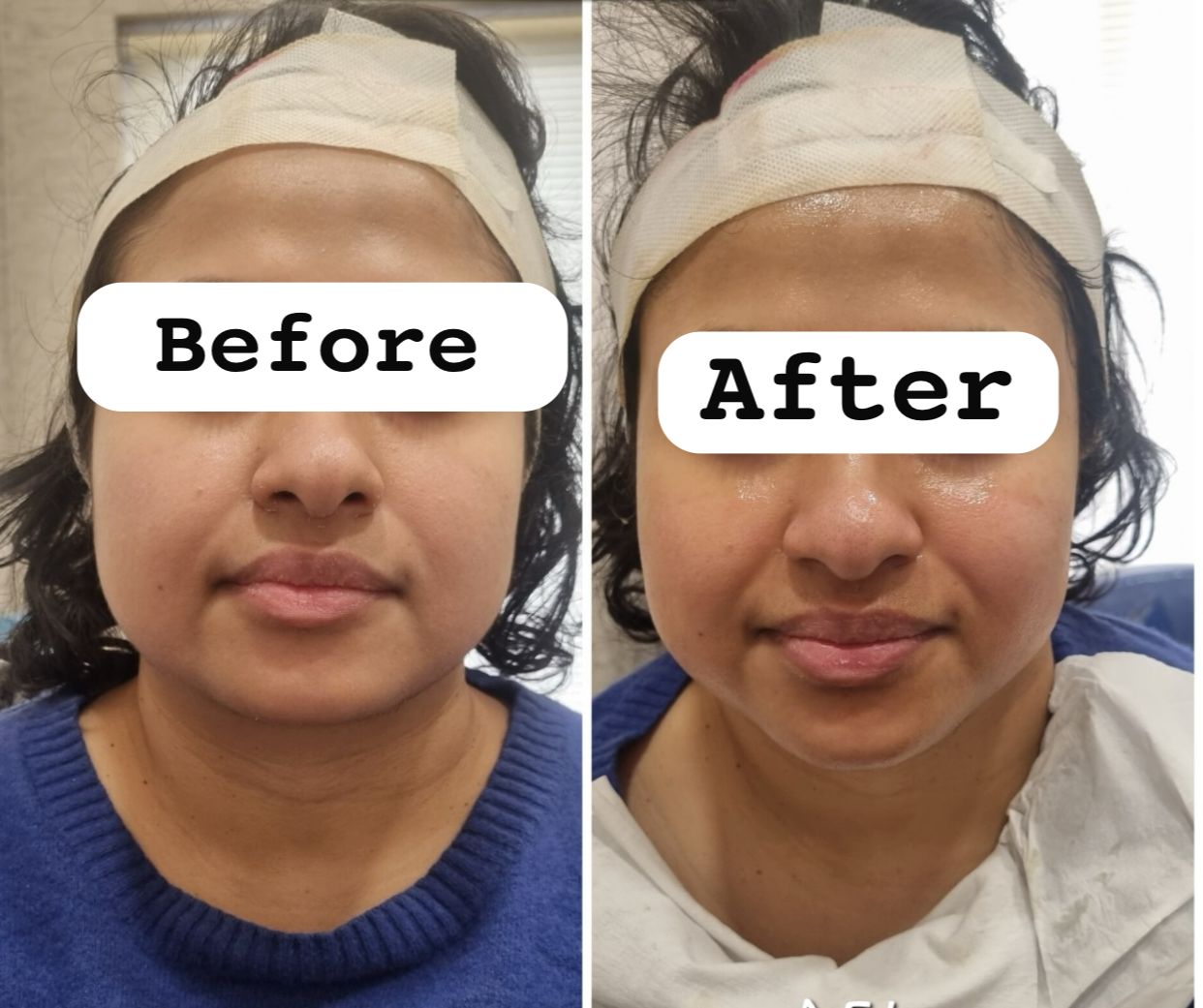 Hydrafacial