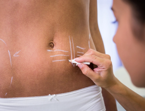 Types of Stretch Marks