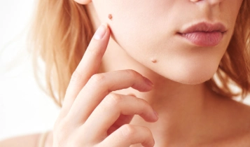 https://ladermaskinclinic.com/wp-content/uploads/2026/03/Face-Moles.webp