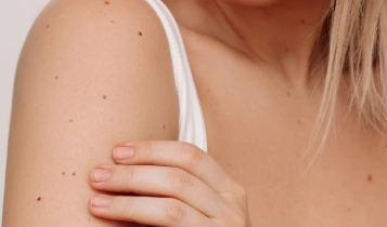 https://ladermaskinclinic.com/wp-content/uploads/2026/03/body-mole.webp