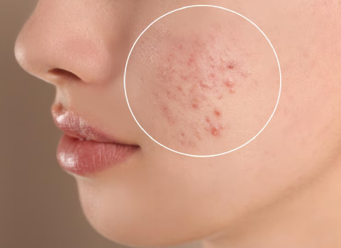 Understanding Acne: What Your Skin Is Trying to Tell You