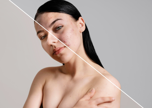 What Are Acne Scars & Their Types?