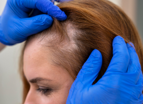 Understanding Hair Loss & Advanced Recovery