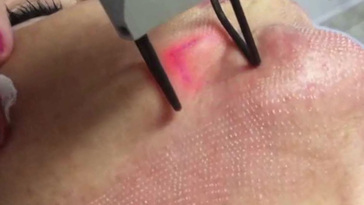 https://ladermaskinclinic.com/wp-content/uploads/2026/07/Fractional-Laser.jpg