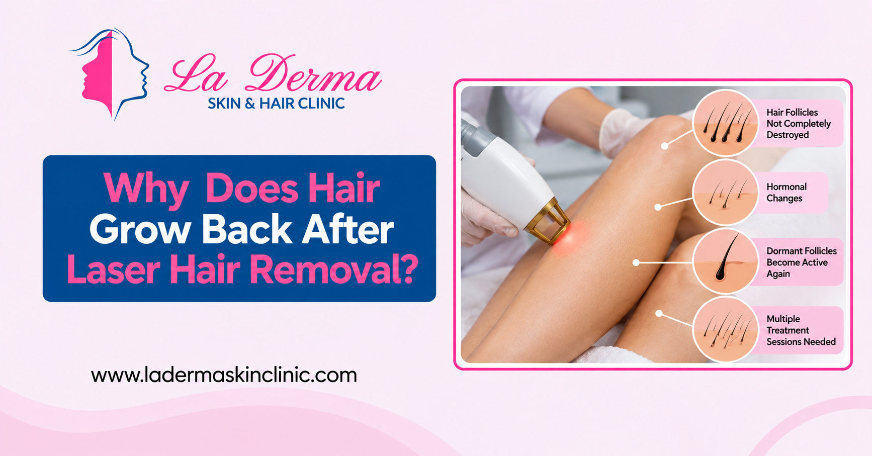 Why Does Hair Grow Back After Laser Hair Removal?