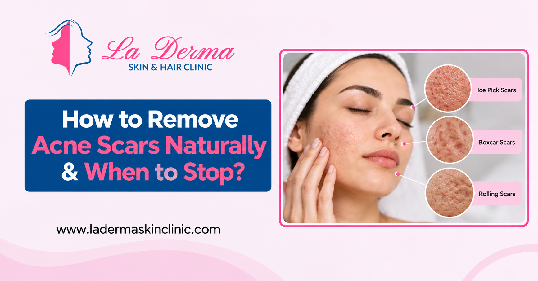 How to Remove Acne Scars Naturally & When to Stop