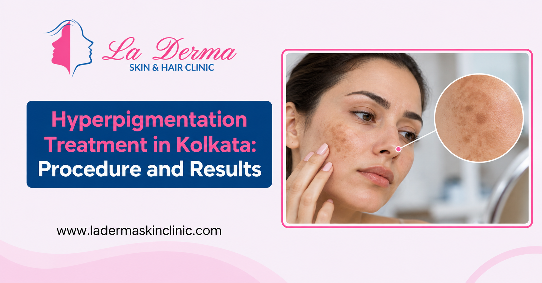 Hyperpigmentation Treatment in Kolkata: Procedure and Results