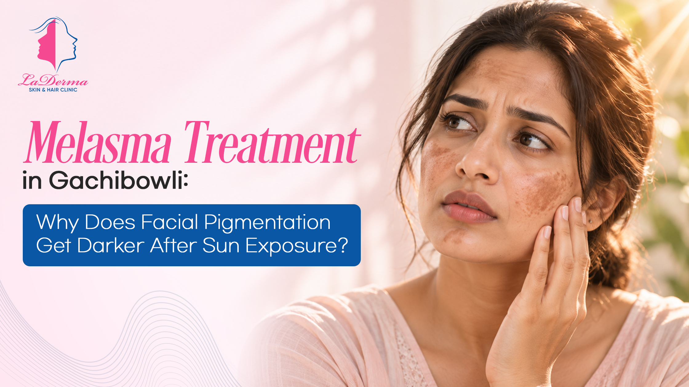 Melasma Treatment in Gachibowli: Why Does Facial Pigmentation Get Darker After Sun Exposure?