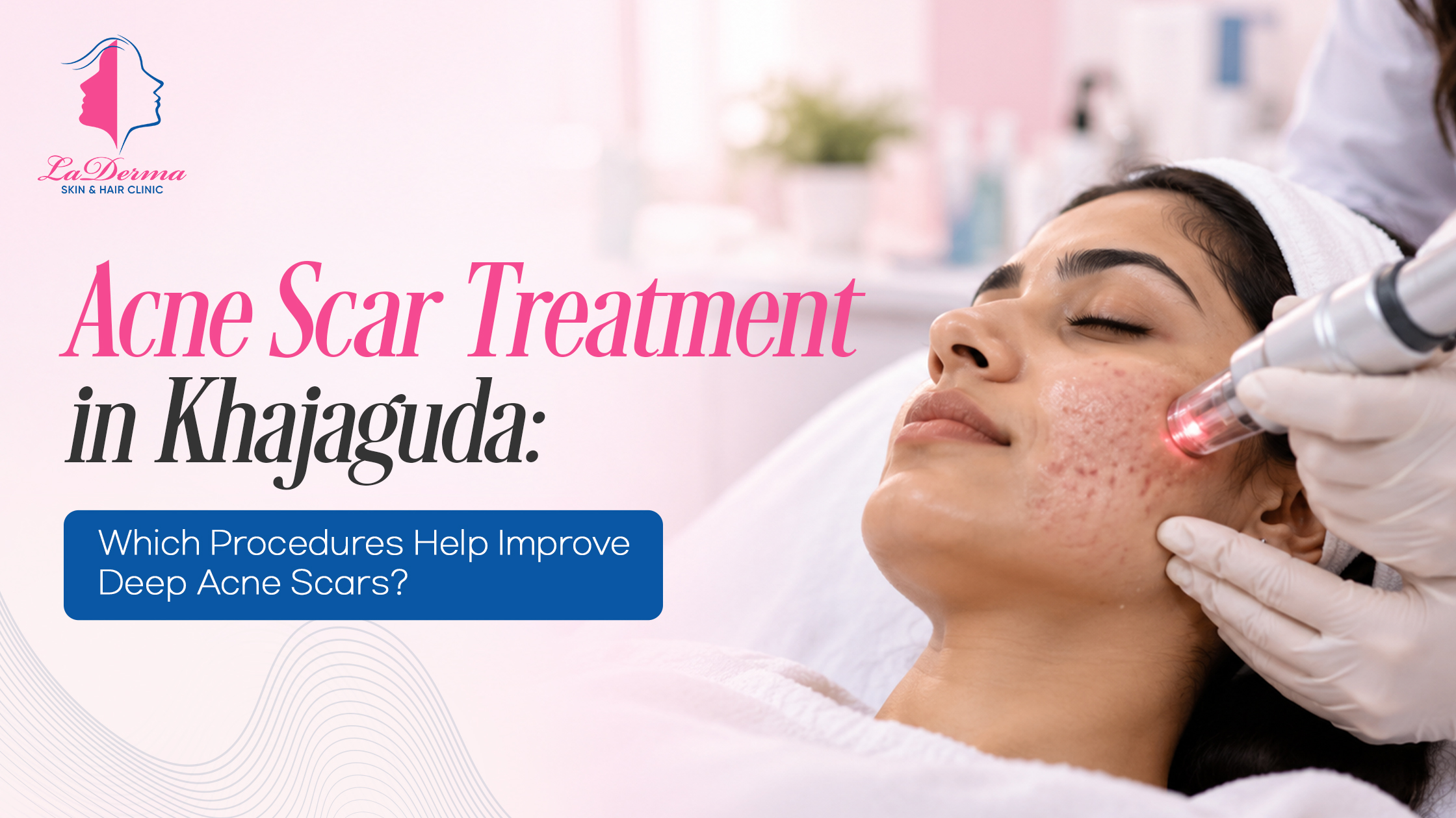Acne Scar Treatment in Khajaguda: Which Procedures Help Improve Deep Acne Scars?