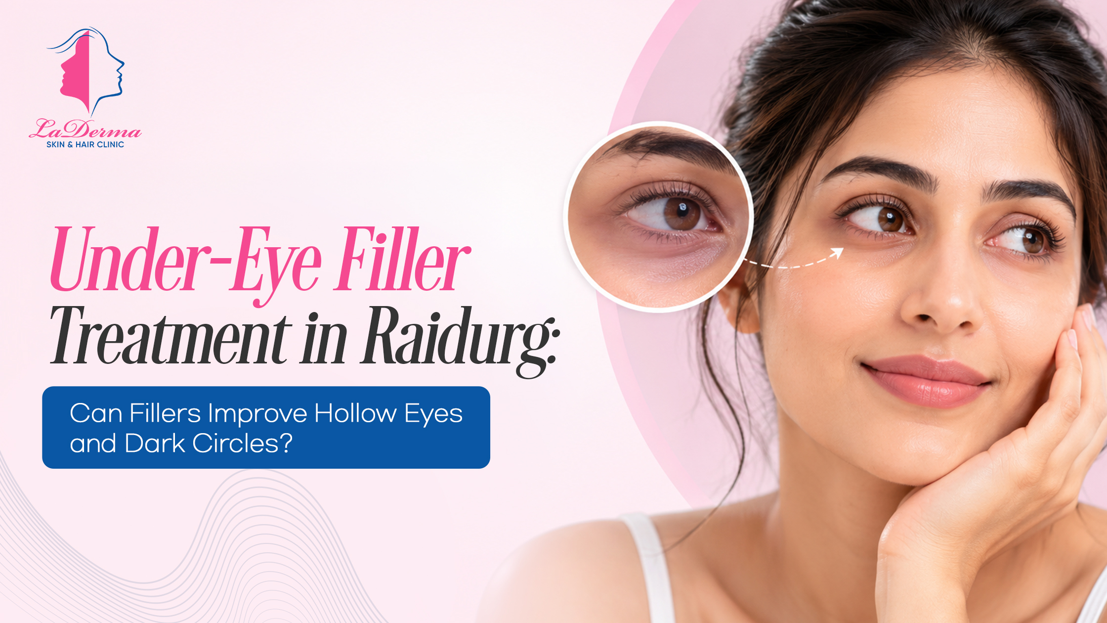 Under-Eye Filler Treatment in Raidurg: Can Fillers Improve Hollow Eyes and Dark Circles?