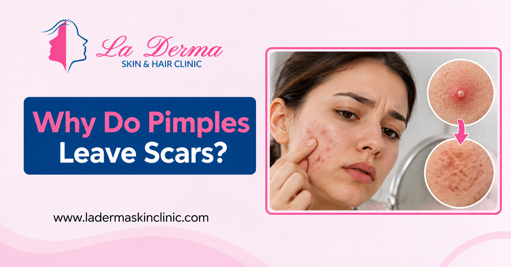 Why Do Pimples Leave Scars?