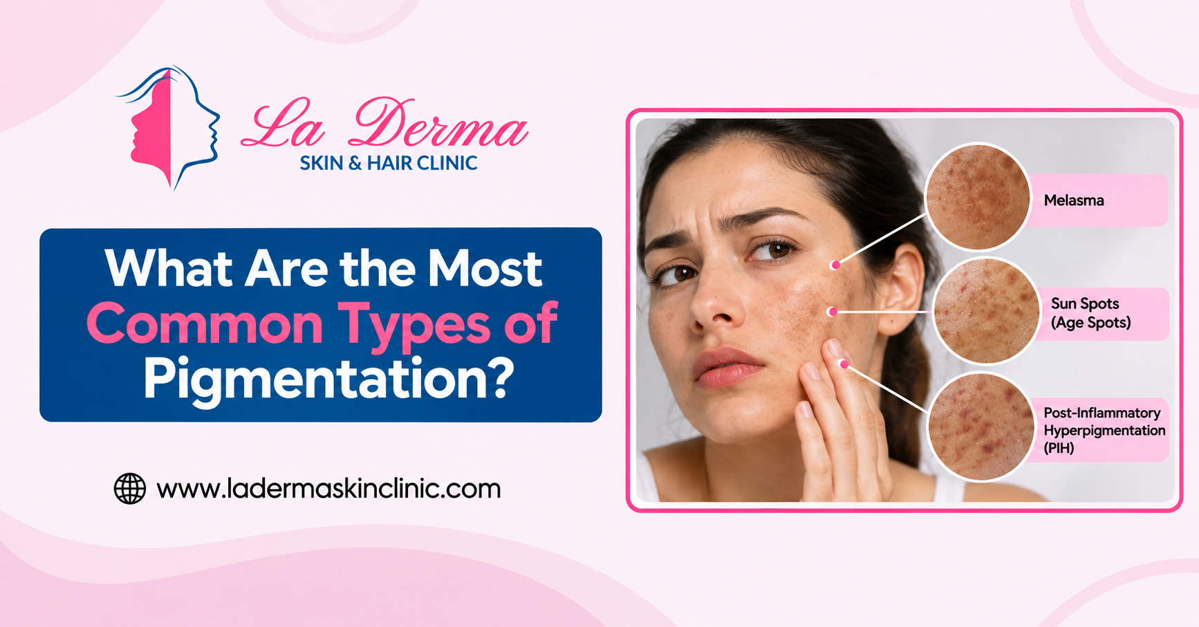 What Are the Most Common Types of Pigmentation?