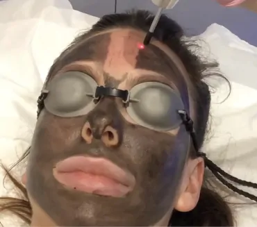  Carbon Laser Facial