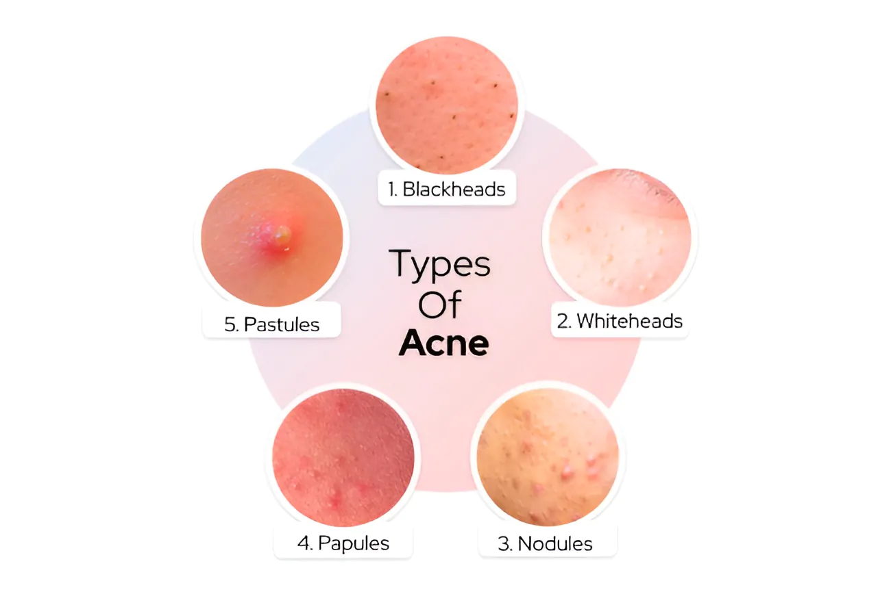 Acne Pimple Treatment in Kolkata