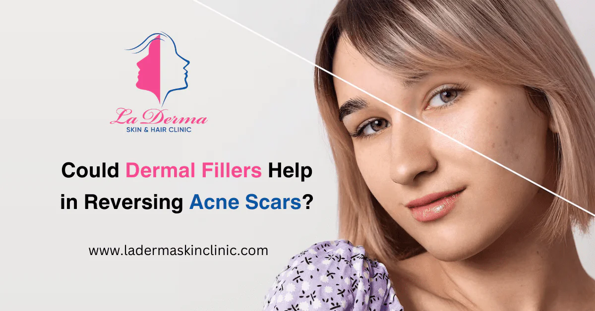 Could Dermal Fillers Help in Reversing Acne Scars?