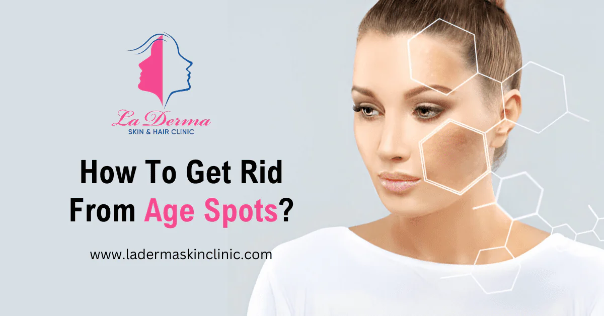 How To Get Rid From Age Spots?