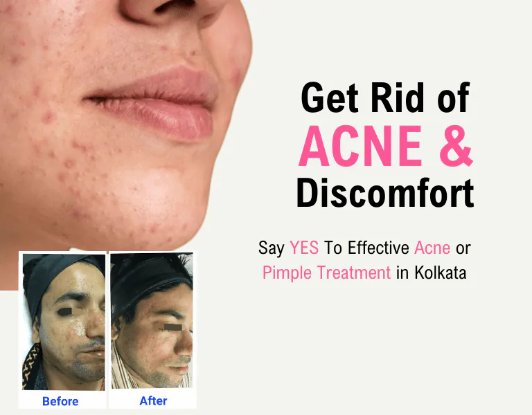 Acne Pimple Treatment 
