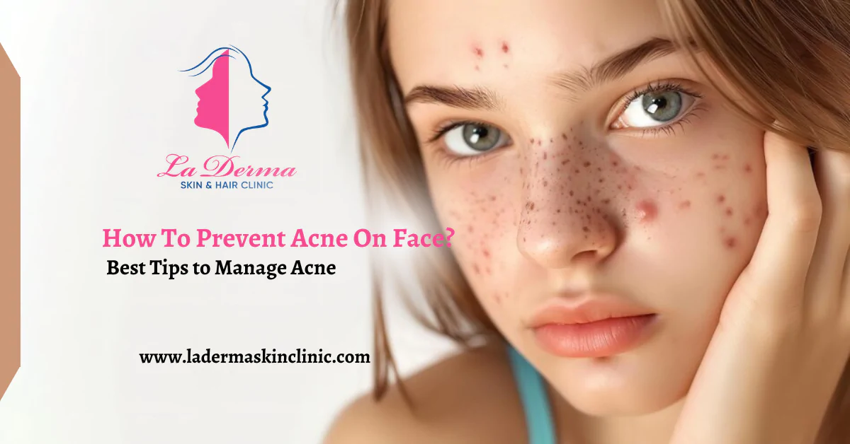 How To Prevent Acne On Face: Best Tips to Manage Acne
