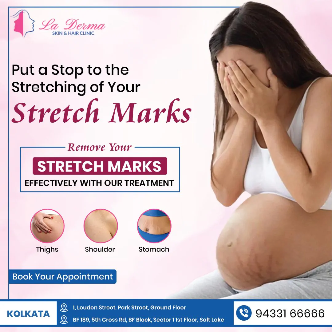 Stretch Marks Treatment at La Derma Skin Clinic