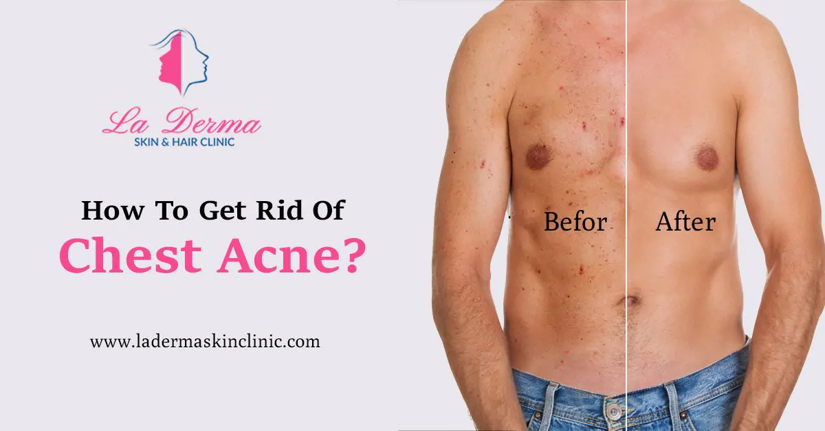 How To Get Rid Of Chest Acne?