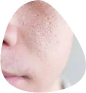 Open Pores