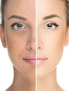 Skin Rejuvenation