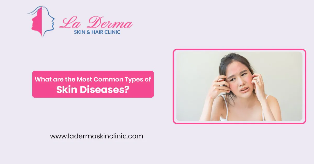 What are the Most Common Types of Skin Diseases?