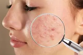 https://ladermaskinclinic.com/wp-content/uploads/2025/10/Acne-Scar-Control.jpeg