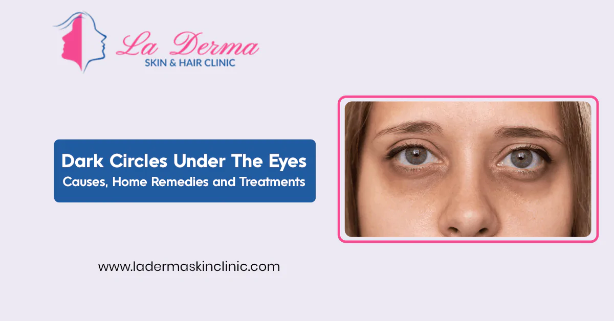 Dark Circles Under The Eyes: Causes, Home Remedies and Treatments